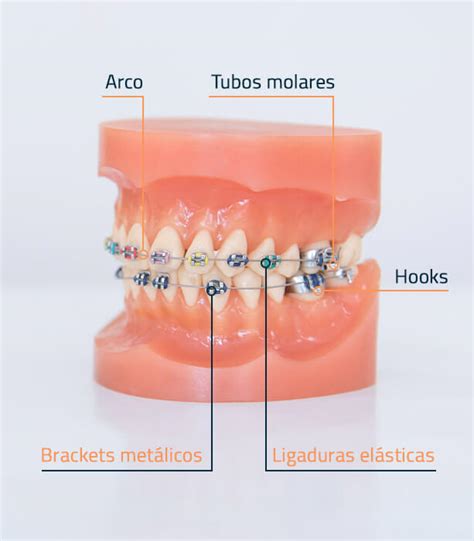 tipos de brackets metalicos pdf|partes de un bracket.